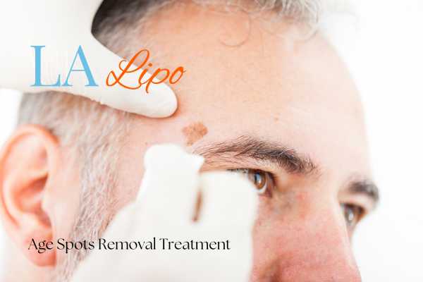 What Are the Most Effective Treatments for Age Spots Crystal Palace?