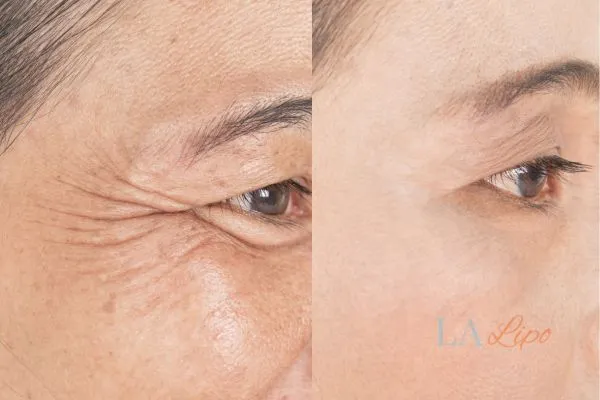 Before and after results of woman - HI-fu wrinkles reduction treatment Crystal Palace