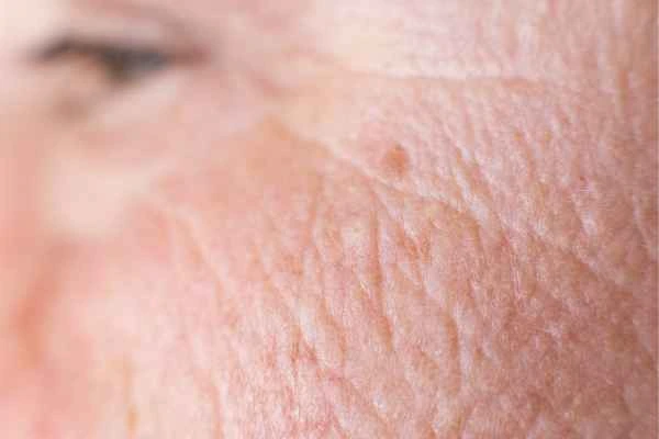 close up picture of a woman's face showing an age spot Crystal Palace