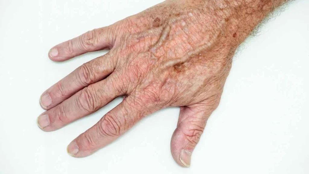 Male hand showing age spot Crystal Palace