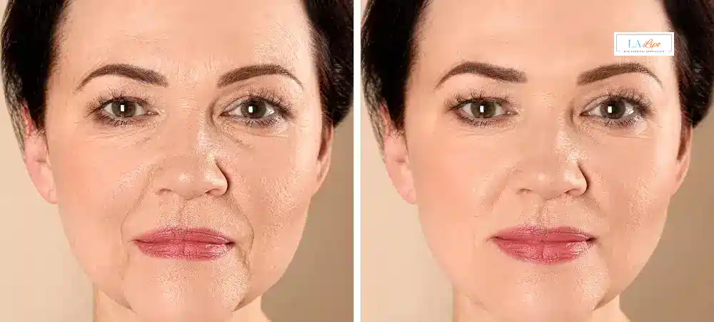 How Long Does It Take to See Results and How Long Do They Last Crystal Palace?